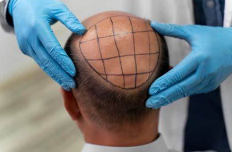Hair Transplantation